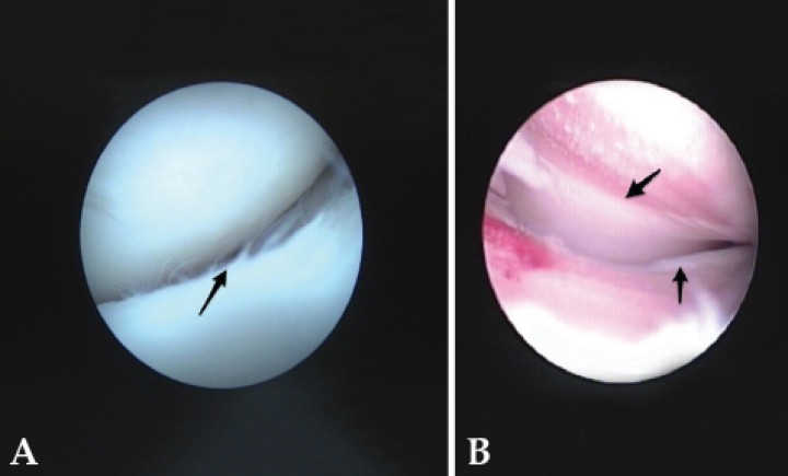<div class=\"Basic-Text-Frame\">
<p>(<strong>A</strong>) Imagen de artroscopia. Ejemplo de grado 2 en la escala Outerbridge: escotadura troclear del cúbito en un codo con signos leves de displasia. Daños mínimos superficiales y fibrilación (flecha) en el cartílago articular. (<strong>B</strong>) Imagen de artroscopia. Ejemplo de grado 4 y 5 en la escala Outerbridge: destrucción completa del cartílago articular y hueso subcondral de aproximadamente el 80% del compartimento medial del codo. Línea de demarcación clara (flechas) entre el compartimento medial y el lateral sano. No se encontró ningún fragmento coronoideo.</p>
</div>