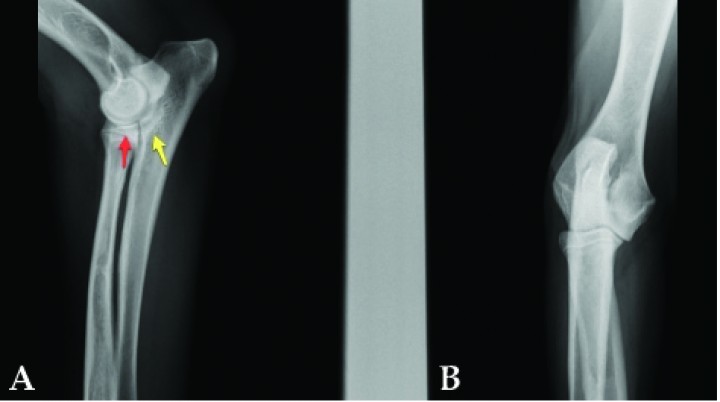 <p>(<strong>A</strong>) Radiografía lateral de un Golden Retriever de 8 meses. (<strong>B</strong>) Radiografía craneocaudal. Se aprecia una muy leve esclerosis subtroclear (flecha amarilla) y definición normal del ápex del coronoides (flecha roja). El animal se trató de forma conservadora hasta que el grado de cojera aconsejó la intervención (véase Fig. 9A).</p>