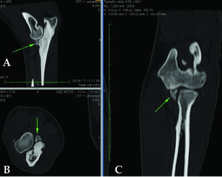 <p>Imágenes de tomografía computarizada en ventana de hueso de un Labrador de 10 meses. (<strong>A</strong>) Plano sagital. (<strong>B</strong>) Plano transversal. (<strong>C</strong>) Plano dorsal. Se observa la fragmentación del proceso coronoides (flechas verdes). Imágenes cedidas por el Departamento de diagnóstico por imagen del Hospital Universitario de Lugo.</p>