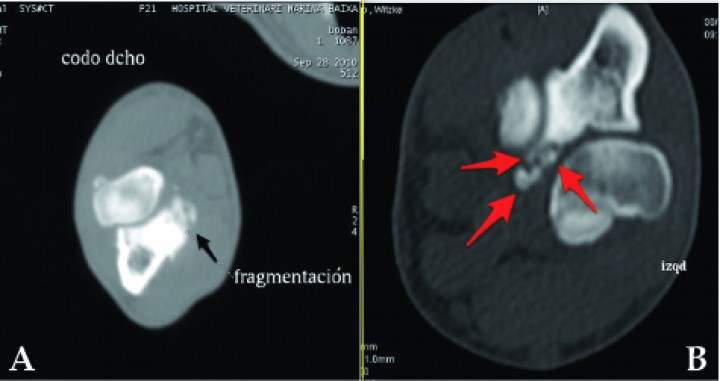 <p>Imágenes de tomografía computarizada en plano transversal y ventana de hueso. Se aprecian diferentes formas de fragmentación coronoidea. (<strong>A</strong>) Fragmentos mínimamente desplazados. (<strong>B</strong>) Multifragmentación con desplazamiento y deformidad de todo el ápex del proceso coronoides.</p>