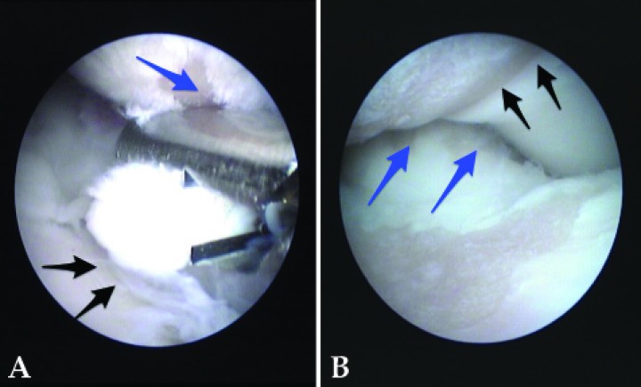 <p>(<strong>A</strong>) Imagen de artrografía del mismo animal de la Figura 6 después de unos meses de evolución. Ejemplo de Erosión del Compartimento Medial Concomitante. Extracción de un pequeño fragmento de coronoides en un Golden Retriever de 15 meses. El cartílago del resto de compartimento medial cubital muestra lesiones de grado 3 y 4 (flechas negras), y el húmero ha desarrollado una “kissing lesion” (lesión por fricción) (flecha azul). (<strong>B</strong>) Imagen de artrografía. Ejemplo de Erosión del Compartimento Medial Primaria. No existen lesiones de OCD ni fragmentación del proceso coronoides. Demarcación clara entre el compartimento medial y el lateral sano (flechas negras). Lesiones profundas del cartílago de la cabeza radial (flechas azules).</p>