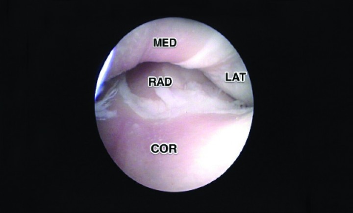 <div class=\"Basic-Text-Frame\">
<p>Imagen de artrografía. Síndrome del compartimento medial (MED) severo y del compartimento lateral (LAT) moderado. La extensión de la erosión alcanza también desde el coronoides (COR) hasta la cabeza del radio (RAD).</p>
</div>