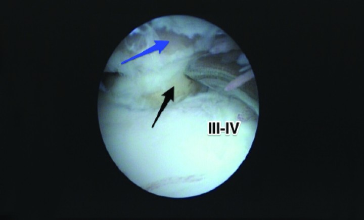 <p>Imagen de artrografía. Desplazamiento con un palpador de un proceso coronoides fragmentado no desplazado (flecha negra). El resto del compartimento medial, sin embargo, está bien conservado a excepción del área adyacente, mostrando lesiones Outerbridge de grado 3-4. El húmero exhibe una “kissing lesion” (flecha azul).</p>