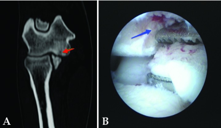 <p>(<strong>A</strong>) Imagen de tomografía computarizada en plano dorsal y ventana de hueso, de un Golden de 9 meses con cojera crónica de bajo grado mostrando el defecto subcondral de una lesión de OCD en el cóndilo humeral (flecha). (<strong>B</strong>). Imagen de artroscopia del mismo animal. Extracción de un flap osteocondral provocado por la OCD. Inmediatamente proximal se aprecia el lecho subcondral sangrante (flecha).</p>