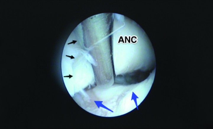 <p>Imagen artroscópica del codo de un Rhodesian Ridgeback de 10 meses con lesiones en el compartimento medial y no unión del proceso ancóneo (ANC). La fisura en el ancóneo se ve claramente (flechas negras), especialmente cuando se moviliza con el palpador. Se aprecian lesiones cartilaginosas profundas distales al agujero supratroclear del húmero (flechas azules).</p>