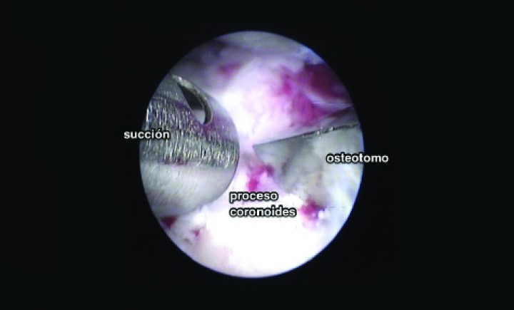 <p>Imagen de artrografía. Coronoidectomía subtotal en un codo con fragmentación coronoidea y erosiones cubitales y humerales. Se está utilizando un osteotomo de 3 mm y una sonda para succión de pequeños fragmentos desprendidos durante el legrado previo.</p>