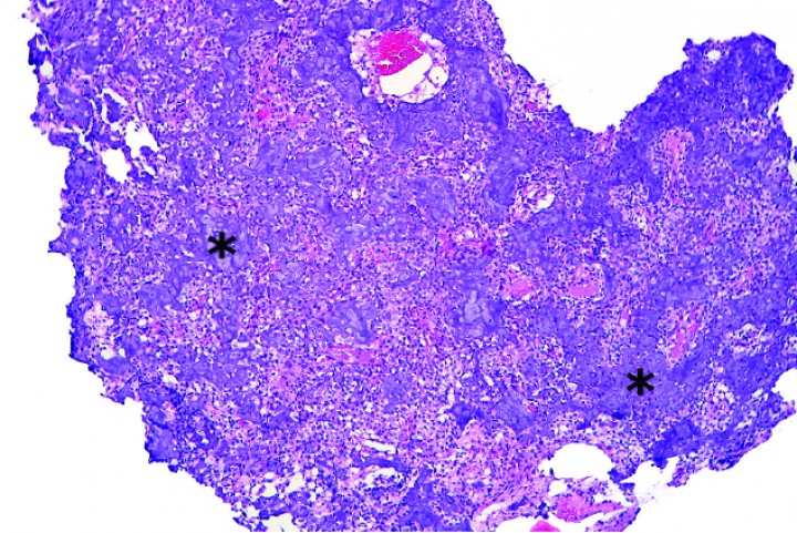 <div class=\"Basic-Text-Frame\">
<p>Cobaya 2. Imagen microscópica de la biopsia de masa craneal. Se observa producción de abundante matriz cartilaginosa (asteriscos) por nidos de condrocitos neoplásicos dispersos entre dicha matriz. (Hematoxilina y eosina, x40).</p>
</div>