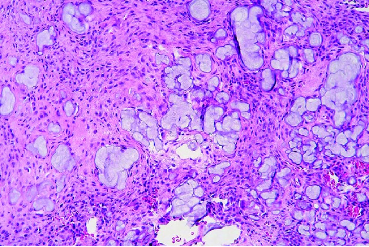 <div class=\"Basic-Text-Frame\">
<p>Cobaya 6. Imagen microscópica de un condrosarcoma tibial, con haces de células fusiformes a fibrohistiocíticas dispersas alrededor de matriz amorfa basófila a grisácea (condroide). (Hematoxilina y eosina, x200).</p>
</div>

<div class=\"frame-2\"> </div>