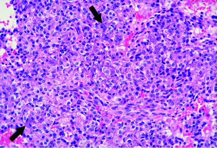 <p>Cobaya 2. Imagen microscópica de una zona de alta densidad celular de un condrosarcoma caracterizada por células predominantemente histiocíticas dispuestas de forma compacta y que producen muy escasa matriz condroide (flechas). (Hematoxilina y eosina, x400).</p>