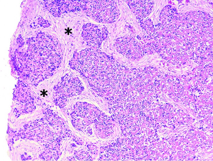 <p>Cobaya 4. Imagen microscópica de zonas con haces de estroma fibroso (asteriscos) en un condrosarcoma. (Hematoxilina y eosina, x120).</p>