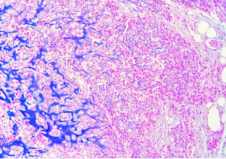 <p>Cobaya 4. Imagen microscópica de una zona altamente celular de un condrosarcoma con transición a una zona de producción de matriz cartilaginosa (azul). (Azul alcián, x220).</p>