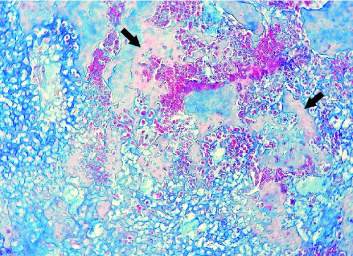 <p>Cobaya 2. Imagen microscópica de una zona rica en matriz cartilaginosa (azul) de un condrosarcoma con depósito incipiente de osteoide (flechas) en un proceso de osificación endocondral del cartílago neoplásico. (Azul alcián, x220).</p>