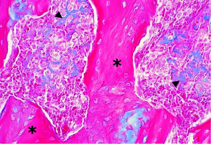 <p>Cobaya 2. Imagen microscópica de una zona de osificación endocondral prominente (asteriscos) de un condrosarcoma con depósitos no osificados de matriz cartilaginosa (cabezas de flecha). (Azul alcián, x480).</p>