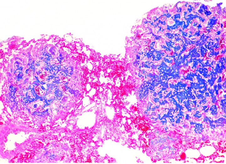 <p>Cobaya 4. Imagen microscópica de metástasis pulmonares de un condrosarcoma que producen abundante matriz cartilaginosa (azul). (Azul alcián, x220).</p>