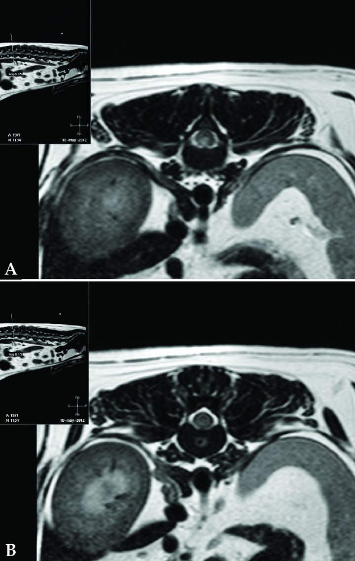<p>Imágenes de Resonancia Magnética. (<strong>A</strong>) Corte transversal sobre el tercio caudal de T13, imagen ponderada en T2. Se observa una alteración de señal intramedular hiperintensa, de límites definidos, algo lateralizada a la derecha. (<strong>B</strong>) Corte transversal sobre el disco intervertebral T13-L1, imagen ponderada en T2. En el núcleo pulposo se observa una disminución de señal focal rodeada de un halo hiperintenso.</p>