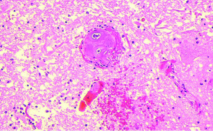 <p>Imagen de anatomía patológica de un émbolo fibrocartilaginoso en un vaso medular, correspondiente a otro caso. (Hematoxilina & Eosina, x20). Cortesía de M. Pumarola.</p>