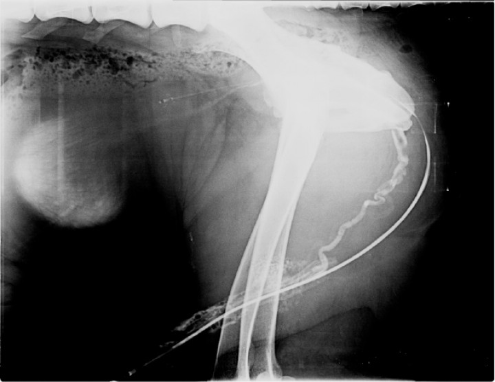 <p>Misma imagen que la Figura 1. Se observa el recorrido de la uretra por la presencia de la sonda uretral y la columna de contraste positivo, con morfología normal en sus segmentos perineal e intrapelviano. Craneal a la uretra perineal se aprecia una segunda estructura tubular, de recorrido sinuoso, que se extiende desde el área intrapelviana hasta el pene. Esta estructura es compatible, por morfología y localización, con la vena dorsal del pene, que desemboca en la vena pudenda interna a nivel de la entrada de la pelvis.</p>