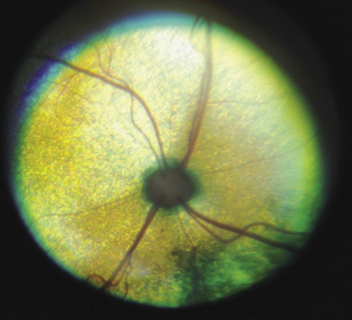 <p>Fondo ocular del OD sin alteraciones.</p>