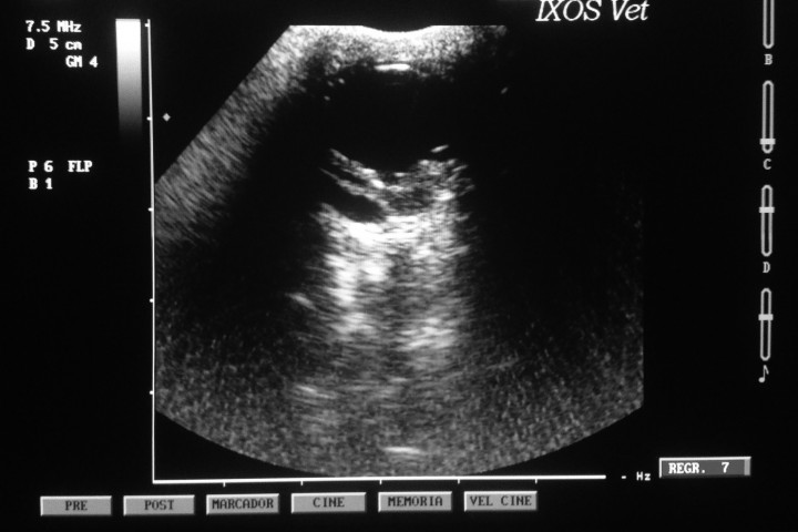 <p>Ecografía del OS; obsérvese el desprendimiento de retina en segmento posterior y la acusada disminución de la cámara anterior.</p>