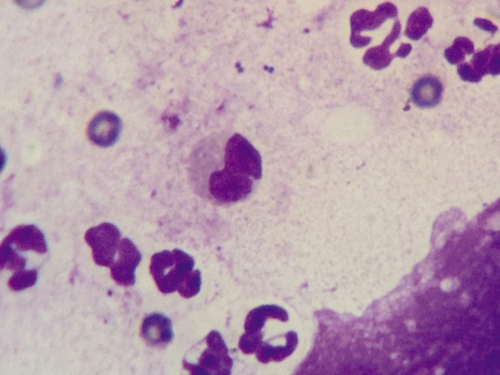 <div class=\"Basic-Text-Frame\">
<p>Citología de las úlceras labiales; se observa la presencia de neutrófilos degenerados, abundantes bacterias (cocos) y unos pocos eosinófilos en la preparación. Tinción Diff-Quick, objetivo de inmersión 100x.</p>
</div>