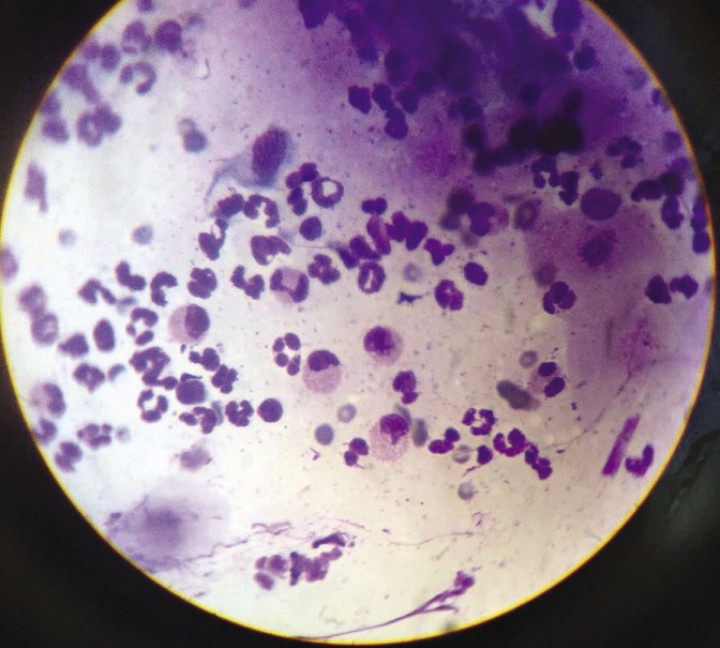 <div class=\"Basic-Text-Frame\">
<p>Citología conjuntival que muestra un infiltrado inflamatorio mixto incluyendo eosinófilos, gránulos eosinofílicos y neutrófilos no degenerados. Tinción Diff-Quick 100x.</p>
</div>