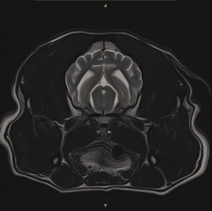 <p>Imagen de encéfalo mediante RM del caso 2. Secuencia ponderada en T2, en plano transversal. Se aprecia una leve dilatación de los ventrículos laterales y un ligero incremento del patrón de surcos y circunvoluciones cerebrales.</p>