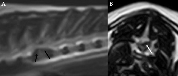 <p>Imágenes de resonancia magnética ponderada en T2W. (<strong>A</strong>) Imagen sagital. (<strong>B</strong>) Imagen transversal. Se aprecia una masa en continuidad dorsal con el cuerpo de T6 (flecha).</p>