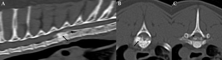<p>(<strong>A</strong>) Reconstrucción sagital de la columna torácica. (<strong>B</strong>) Imagen transversal a nivel del cuerpo vertebral de T6 obtenida mediante mielo-TC. (<strong>C</strong>) Imagen transversal a nivel del borde caudal del cuerpo vertebral de T6 obtenida mediante mielo-TC. Se aprecia engrosamiento del cuerpo y pedículo izquierdo de T6 con compromiso del canal vertebral por la lesión epidural hiperatenuante de bordes bien definidos y áreas de hipoatenuación que le confieren un aspecto granulado (flechas en <strong>A</strong> y <strong>B</strong>). Nótese la deformación del cordón medular característica de una lesión epidural (puntas de flechas en <strong>A</strong> y <strong>C</strong>).</p>