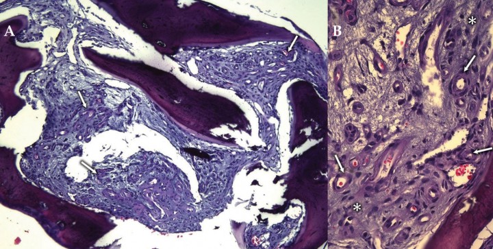 <div class=\"Basic-Text-Frame\">
<p>(<strong>A</strong>) Imagen microscópica en la que se aprecia tejido óseo trabecular con escasa población hematopoyética que ha sido sustituida por tejido conjuntivo laxo que contiene estructuras vasculares de diferente calibre (flechas). (<strong>B</strong>) Imagen microscópica en la que se aprecian capilares con endotelio reactivo (morfología fusiforme, núcleo hipercromático y cromatina densa) (flechas) rodeados de fibras musculares lisas en un estroma conjuntivo basófilo (asterisco). Hematoxilina-Eosina (<strong>A</strong> y <strong>B</strong>) . Aumentos: 20x (<strong>A</strong>) y 200x (<strong>B</strong>).</p>
</div>