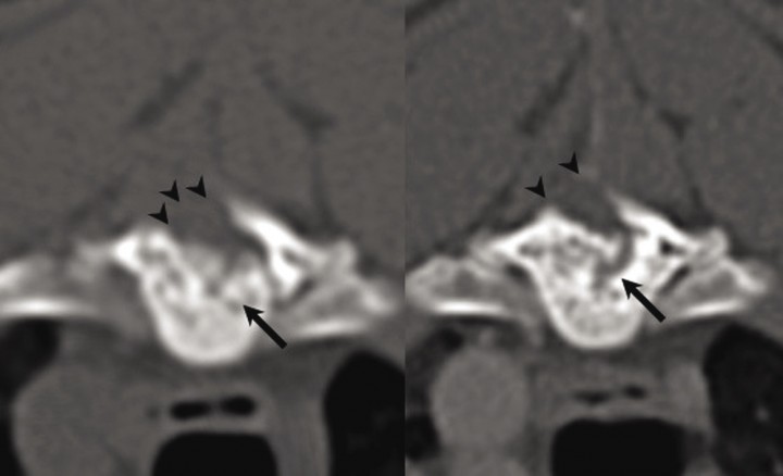 <div class=\"Basic-Text-Frame\">
<p>Imagen transversal obtenida mediante TC. (<strong>A</strong>) 6 meses y (<strong>B</strong>) 2 años después de la cirugía. Se aprecia un remanente de tejido óseo trabeculado con áreas punteadas de hipoatenuación originado a partir del cuerpo de T6 (flechas) así como el defecto creado por la hemilaminectomía (puntas de flecha). Nótese el carácter levemente progresivo, evidenciado por un mayor tamaño de la lesión en la imagen <strong>B</strong>.</p>
</div>