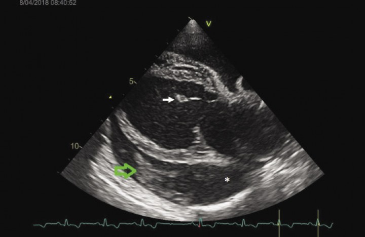 <p>Imagen ecocardiográfica: eje largo paraesternal derecho. El asterisco marca el líquido pericárdico anecoico y la flecha verde, el coágulo. La flecha blanca señala la hoja valvular de la válvula mitral.</p>