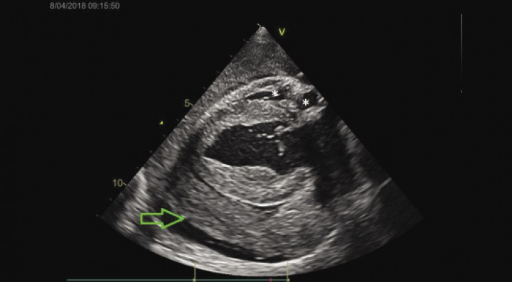 <p>Imagen ecocardiográfica: eje largo paraesternal derecho. La flecha verde señala el coágulo de grandes dimensiones y los asteriscos, el colapso de la aurícula y el ventrículo derecho.</p>