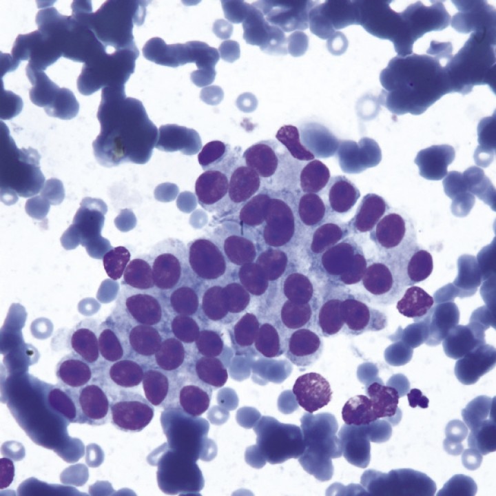 <p>Citología de insulinoma. En la muestra, obtenida mediante punción con aguja fina ecoguiada de un nódulo pancreático, se observa un cluster de células epiteliales englobadas en una matriz basófila granular. Se aprecian 1-2 nucléolos y vacuolización citoplasmática, así como moderada anisocitosis y anisocariosis. Dichos hallazgos confirman la presencia de una neoplasia de origen neuroendocrino, en este caso un insulinoma debido a su localización en el páncreas (Diff-Quick, 100x).</p>