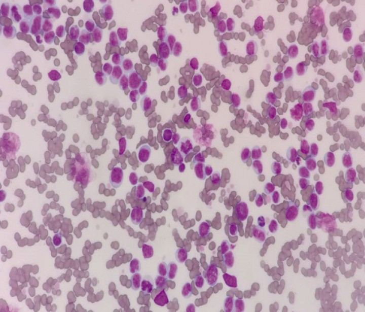 <p>Frotis sanguíneo en paciente felino con leucostasis. Nótese el elevado número de linfoblastos en el frotis de sangre. En este caso de linfoma mediastínico complicado con leucostasis el recuento total de células blancas en sangre periférica era de 349 970/μl (Diff-Quick, 100x).</p>