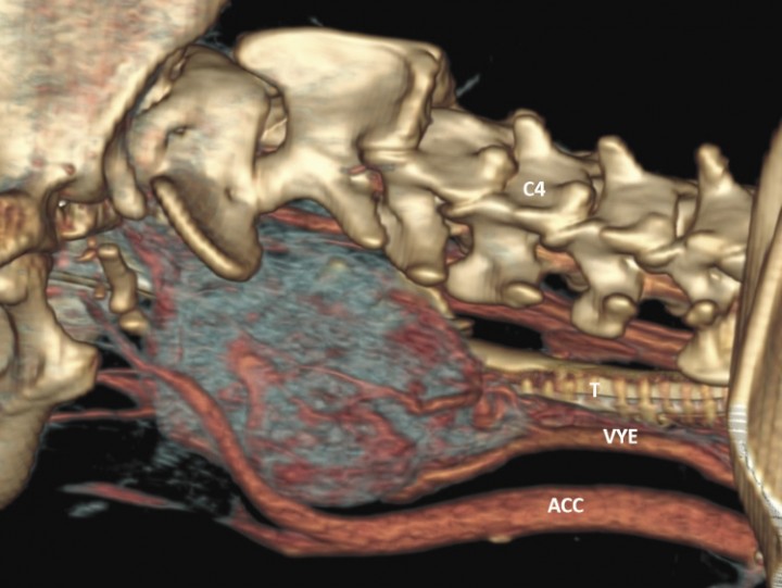 <p>Reconstrucción 3D sagital de la masa cervical izquierda (desde la base del cráneo hasta C3-C4, ventralmente) (ACC: arteria carótida común; VYE: vena yugular interna; T: tráquea).</p>