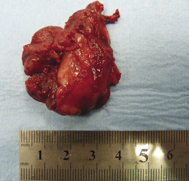 <p>Totalidad de la masa extraída que evidencia sus dimensiones (3 x 4 cm).</p>