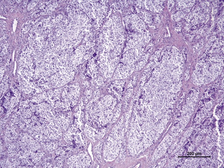 <p>Tinción de hematoxilina-eosina en la cual se aprecian paquetes compactos de células neoplásicas separados por trabéculas de tejido fibroconjuntivo. Las células neoplásicas tienen una forma de redonda a poliédrica y un citoplasma pálido granular. 100x.</p>