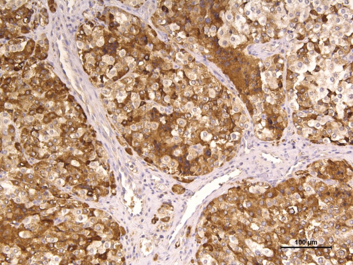 <p>Inmunohistoquímica frente a cromogranina. Nótese que todas las células neoplásicas presentan inmunopositividad citoplasmática intensa. 200x.</p>