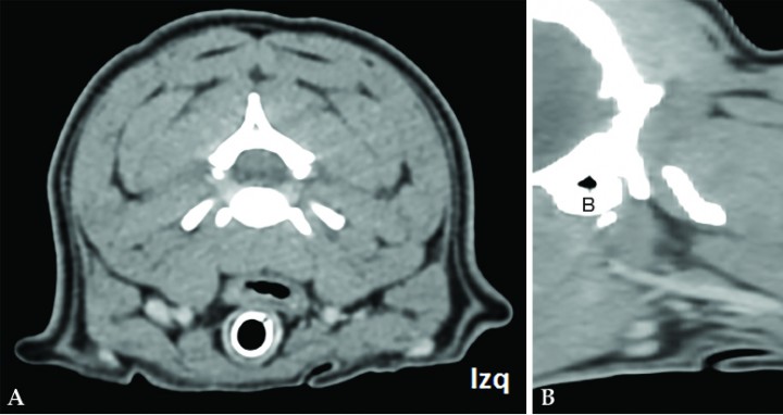<p>Control posoperatorio de la porción cervical en ventana de tejido blando poscontraste. (<strong>A</strong>) Plano transversal. (<strong>B</strong>) Plano sagital. No se detecta la masa previamente descrita. (B: bulla timpánica izquierda).</p>