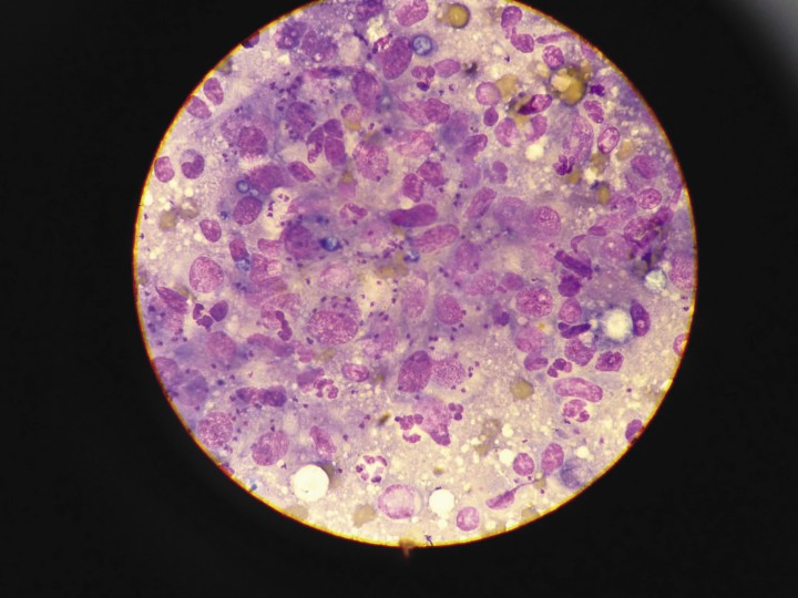<p>Amastigotes de Leishmania en citología hepática por punción ecoguiada con aguja fina. Diff-Quick. 100x.</p>