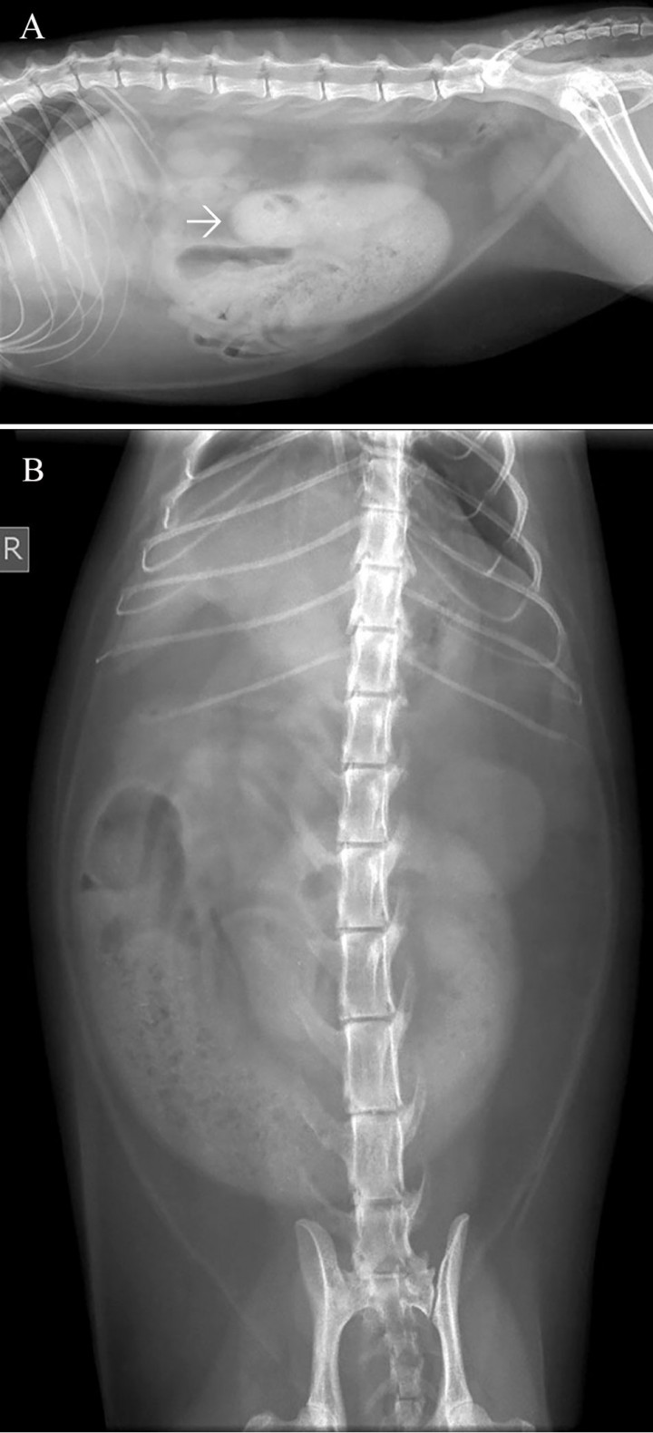 <p>Mismas radiografías que en la Figura 1. Se observa el asa distendida (flechas) con un contenido de opacidad mixta y aspecto granular con pequeñas estructuras radiopacas, compatible con un signo de grava.</p>