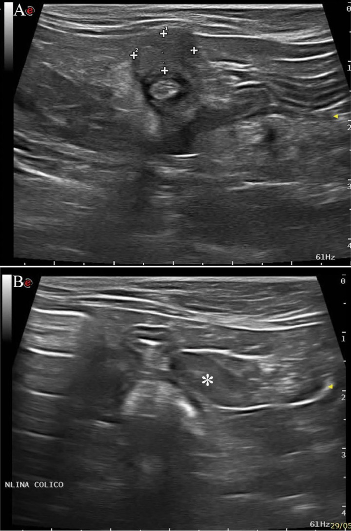 <p>Imágenes ecográficas. (<strong>A</strong>) Zona ileocólica en la que se observa una masa excéntrica hipoecogénica y de ecotextura heterogénea (<em>calipers</em>), que presenta un tamaño aproximado de 1 cm x 0,8 cm, con pérdida de visualización de las capas intestinales. (<strong>B</strong>) Nódulo linfático cólico (asterisco), aumentado de tamaño con aspecto ecográfico normal.</p>