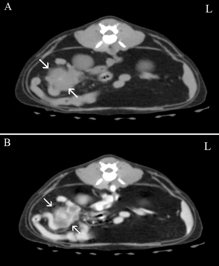 <p>Imágenes de TC en plano transversal y ventana de tejido blando. (<strong>A</strong>) Precontraste. (<strong>B</strong>) Poscontraste. Se observa una masa con origen en la válvula ileocecal (flecha) que produce un realce heterogéneo tras la administración del contraste. L: izquierda.</p>