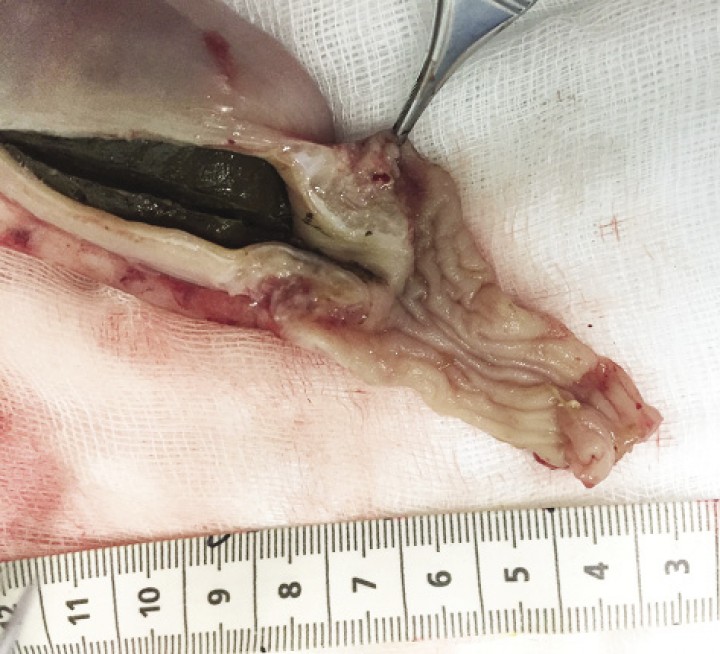 <p>Imagen macroscópica del asa intestinal tras la enterectomía. Se observa un engrosamiento de la pared intestinal simétrico, que produce un estrechamiento de la luz intestinal.</p>