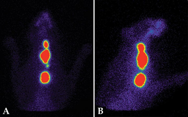 <p>Gammagrafía tiroidea de un gato con hipertiroidismo grave, patrón multifocal. (<strong>A</strong>) Imagen ventral. (<strong>B</strong>) Imagen lateral. Presencia de varias zonas de marcada captación de <sup>99m</sup>Tc-pertecnetato (ratio T/S: 50,7) en región cervical y torácica. Las lesiones presentan un gran volumen (>10 cm<sup>3</sup>) y están mal delimitadas (bordes irregulares). Esta imagen es compatible con sospecha de carcinoma tiroideo. El paciente fue tratado con éxito con dosis altas de <sup>131</sup>I (30 mCi).</p>