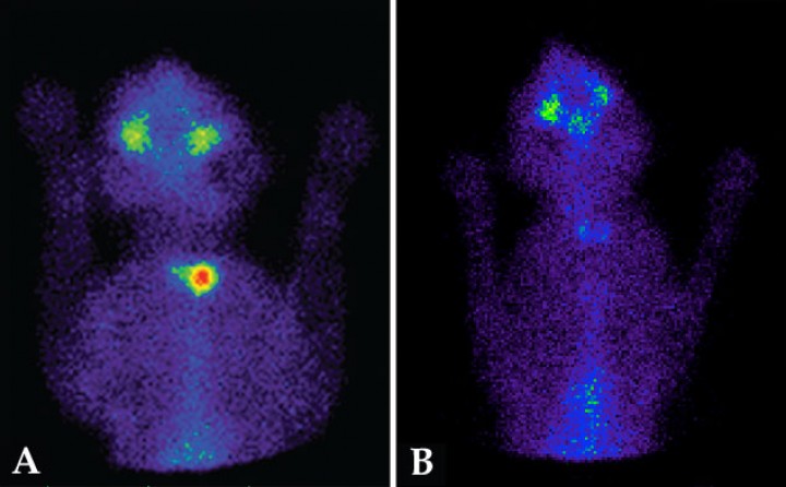 <p>Gammagrafía tiroidea en hipertiroidismo oculto y en falso positivo laboratorial. (<strong>A</strong>) Gato con valores de T<sub>4</sub> total (3 µg/dl) dentro del rango de referencia (0,9-4,7 µg/dl). El estudio con gammagrafía muestra tejido hiperfuncional en el lóbulo izquierdo (hipertiroidismo oculto). (<strong>B</strong>) Gato con valores de T<sub>4</sub> total elevados (5,4 µg/dl) sospechoso de hipertiroidismo. Gammagrafía tiroidea normal, sin alteración en la captación del radiofármaco (ratio T/S: 0,7). Compatible con gato sin lesión tiroidea (falso positivo laboratorial).</p>