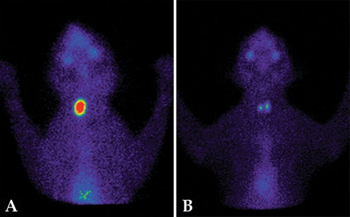<p>Gammagrafías tiroideas, pretratamiento y postratamiento con <sup>131</sup>I, de un gato hipertiroideo. (<strong>A</strong>) Gammagrafía pretratamiento que muestra un patrón unilateral derecho con aumento de captación de <sup>99m</sup>Tc-pertecnetato (ratio T/S: 4,5). El paciente fue tratado con una dosis baja de <sup>131</sup>I (1,4 mCi), ajustada en base a los datos obtenidos en la gammagrafía previa. (<strong>B</strong>) Gammagrafía a los 6 meses postratamiento, que muestra el restablecimiento del eutiroidismo sin producir hipotiroidismo iatrogénico (ratio T/S: 1,2).</p>