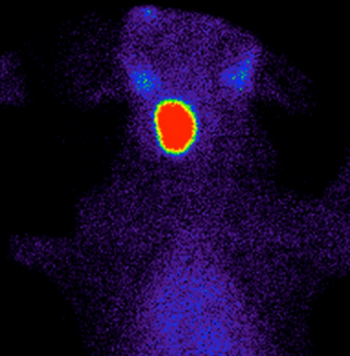 <p>Gammagrafía tiroidea de un perro con elevación en la T<sub>4</sub> total y sintomatología compatible con hipertiroidismo. Se observa un aumento de tamaño y captación de <sup>99m</sup>Tc-pertecnetato (ratio T/S: 7) del lóbulo tiroideo derecho con supresión del lóbulo contralateral (no visible en la gammagrafía). La imagen es compatible con un tumor tiroideo hiperfuncional unilateral, sin invasión de tejidos adyacentes ni metástasis, por lo que la tiroidectomía sería el tratamiento de elección en este caso.</p>