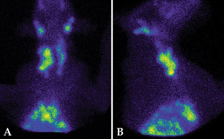 <p>Gammagrafía tiroidea de un perro con masa palpable en la región cervical. (<strong>A</strong>) Imagen ventral. (<strong>B</strong>) Imagen lateral. Aumento de tamaño de ambos lóbulos tiroideos, con márgenes irregulares y sin aumento de captación de <sup>99m</sup>Tc-pertecnetato (ratio T/S: 1,4). En tórax se observa un aumento de captación compatible con metástasis. La imagen es compatible con carcinoma tiroideo bilateral no hiperfuncional, con infiltración de los tejidos adyacentes y metástasis pulmonares, por lo que el tratamiento quirúrgico no estaría indicado.</p>