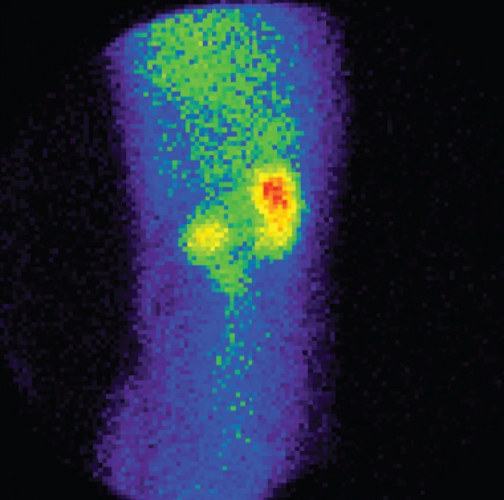 <p>Imagen sumatoria de la gammagrafía renal dinámica en una perra con valores de creatinina normal. Aumento de la actividad del flujo sanguíneo en el tórax por la disminución en el aclaramiento renal, con muy baja captación del radiofármaco por el riñón izquierdo. Tasas de filtración glomerular disminuidas: TFG global de 0,57 ml/min/kg (N: >3 ml/min/kg); TFG del riñón derecho de 0,50 ml/min/kg; TFG del riñón izquierdo de 0,07 ml/min/kg. El estudio es compatible con enfermedad renal subclínica, en la que el riñón izquierdo prácticamente no contribuye a la funcionalidad renal.</p>
